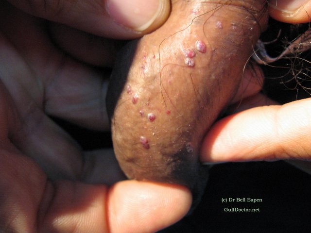 violist vals vergeetachtig Penile Lesions - Dermatologists Sans Borders