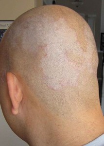 English: Picture of Seborrhoeic Dermatitis.