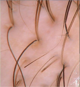 Trichoscopy image of alopecia areata