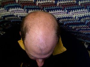 English: Bald head
