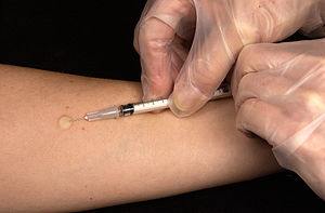 The Mantoux skin test consists of an intraderm...
