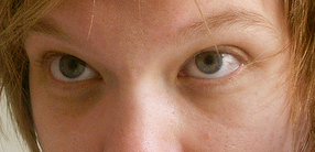 Example of dark circles