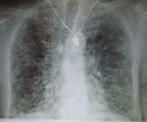 English: Pulmonary fibrosis induced by amiodarone.