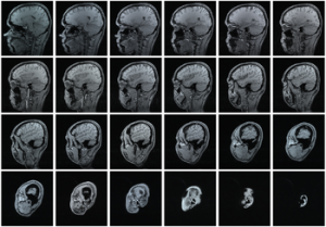 Magnetic resonance imaging (MRI) series of a h...