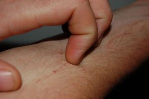 English: A hand scratching at a pruritus on arm
