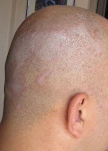 English: Picture of Seborrhoeic Dermatitis.