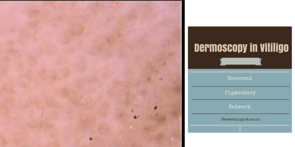 Dermoscopy in Vitiligo