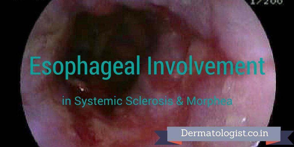 Esophageal Involvement in Systemic Sclerosis & Morphea