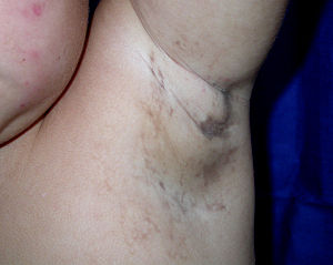 Axillary Pigmentation