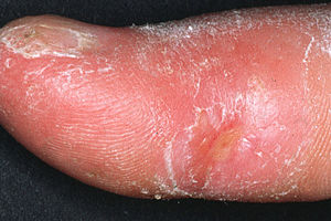 300px-Systemic_sclerosis_finger