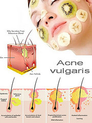 Acne Vulgaris