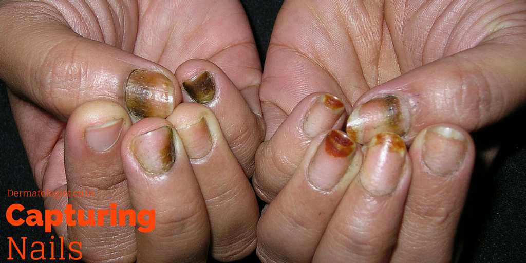 nail disorders