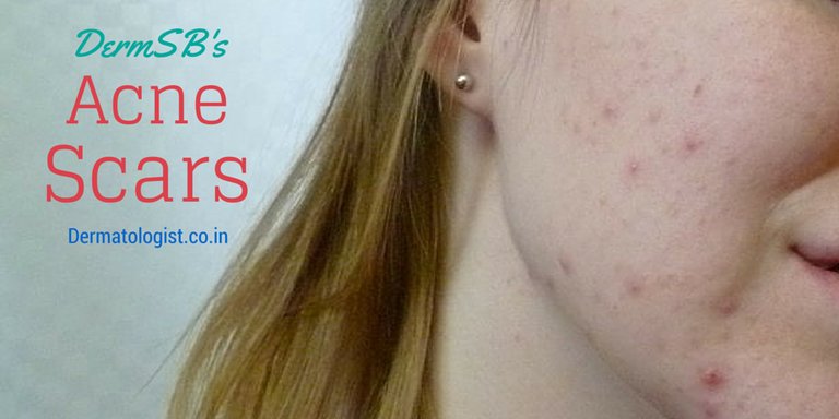 acne scars